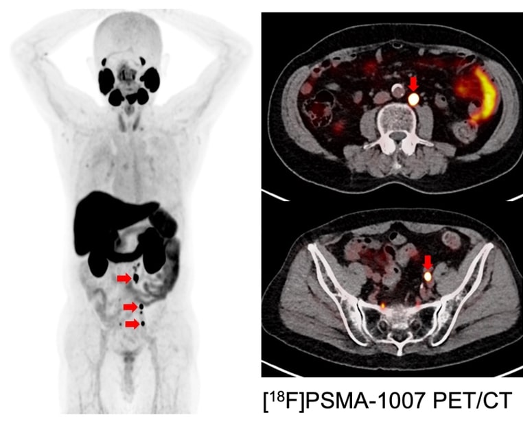 乏転移性前立腺がん患者の今後の見通しはどのようなものですか?