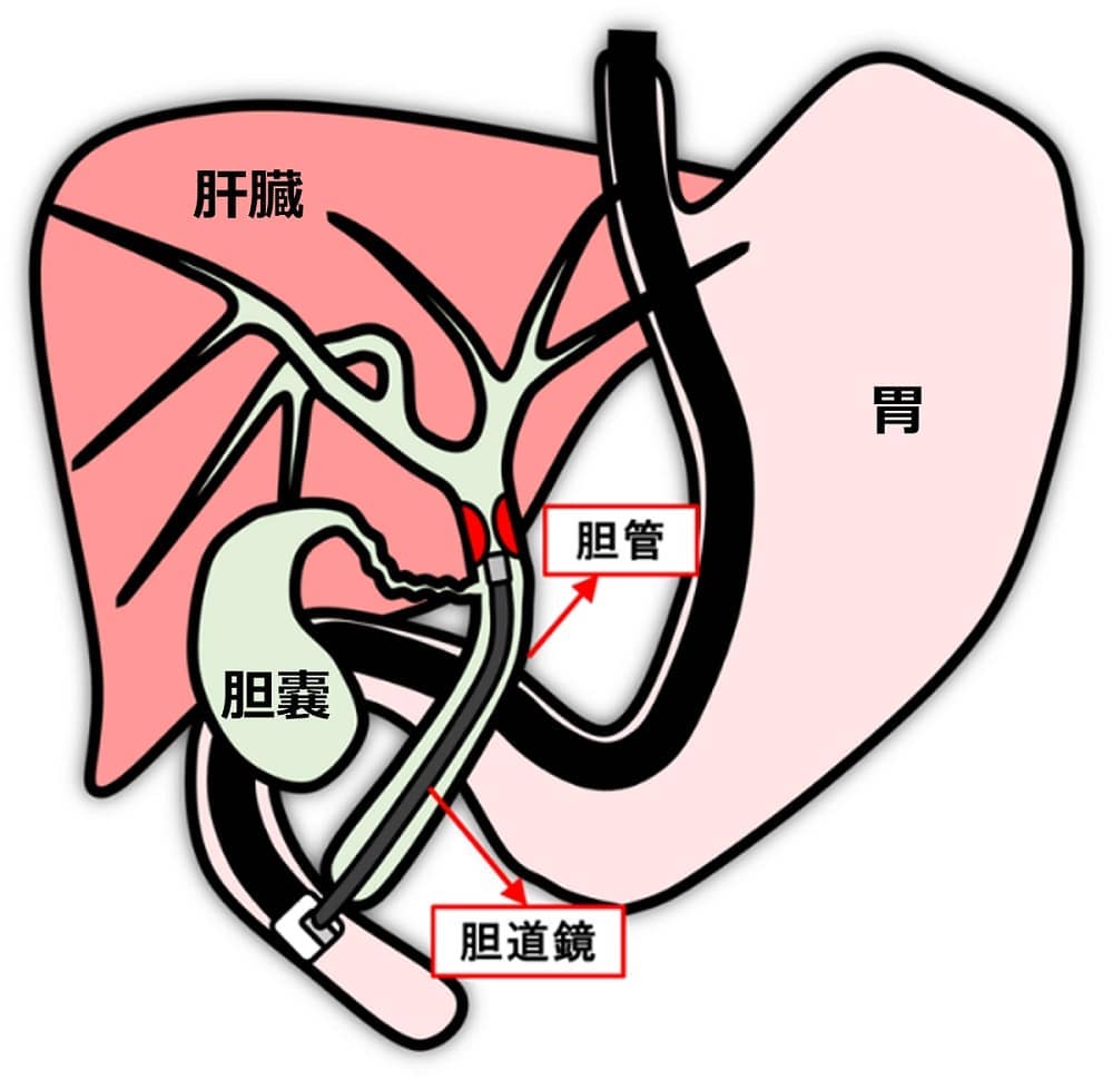 国内初、AIを用いた胆道がん診断支援技術：医療機器ニュース - MONOist